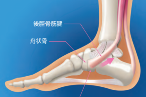 ダンサーの有痛性外脛骨 手術するしかない と言われたけど 筋膜マニピュレーション で改善